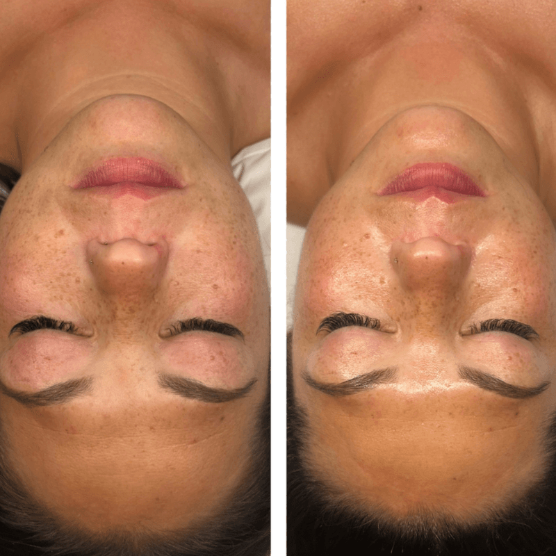 Before and after Thesera H Glass Skin facial