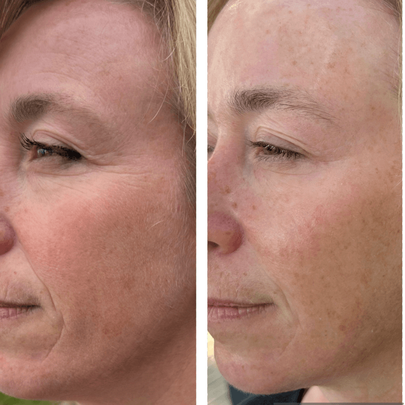Corrective Facials